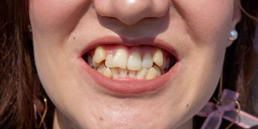 curved-female-teeth-before-installing-braces-close-up-teeth-before-treatment-by-orthodontist-min