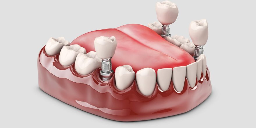 human-teeth-dental-implant-3d-illustration-min