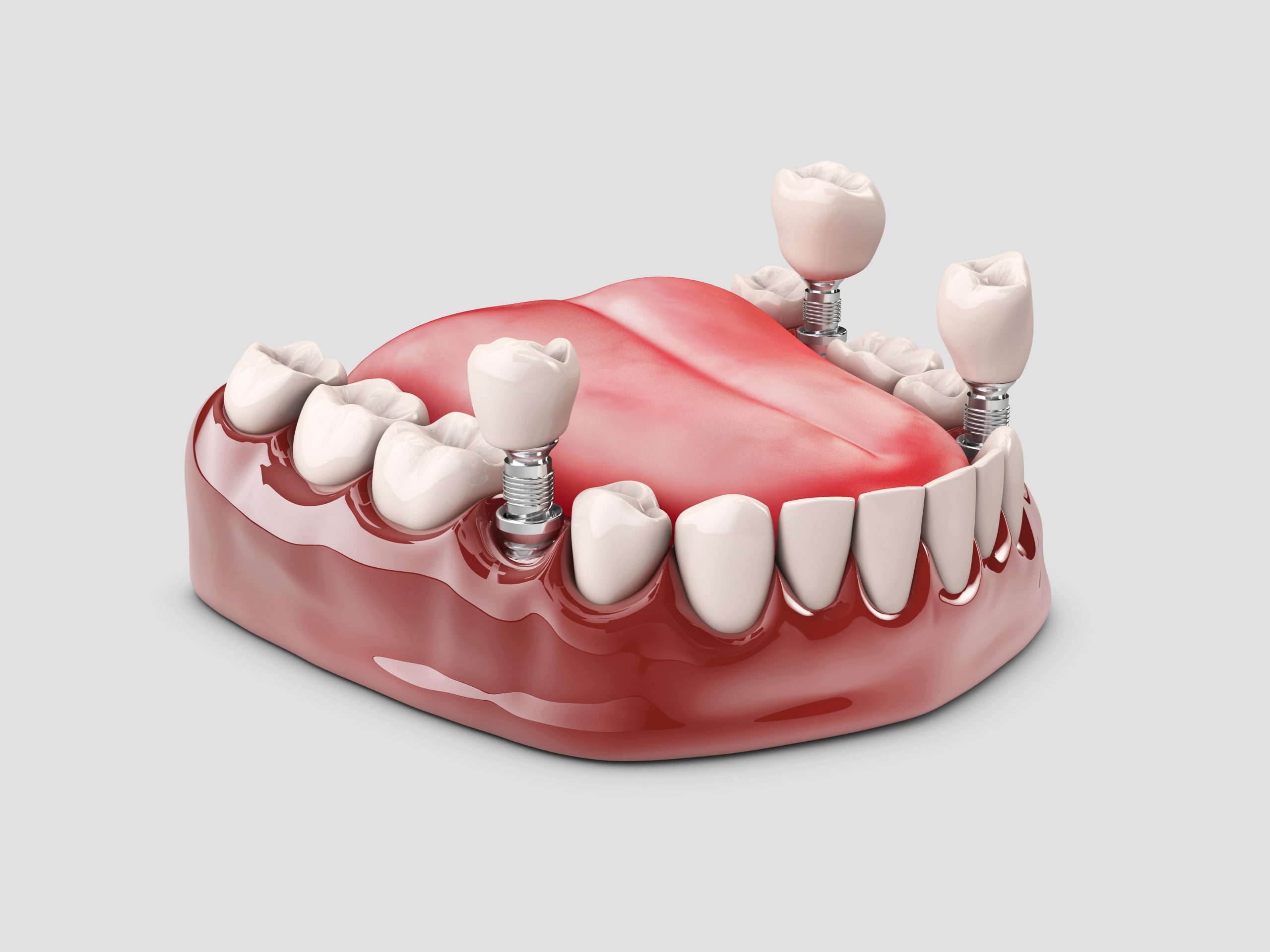 DENTAL İMPLANT NASIL YAPILIR ?