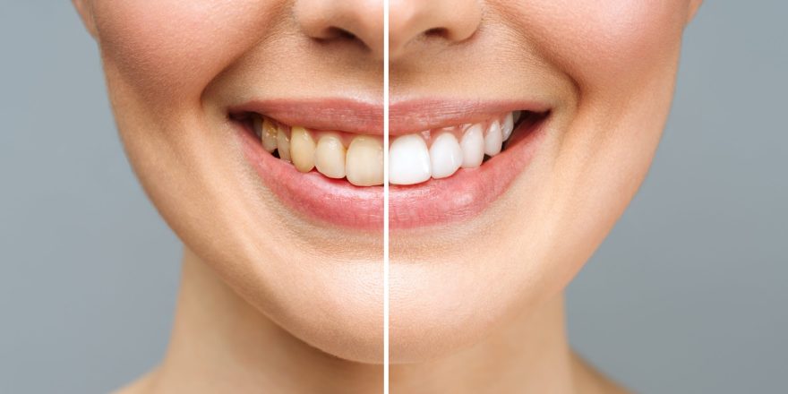 woman-teeth-before-after-whitening-white-background-dental-clinic-patient-image-symbolizes-min